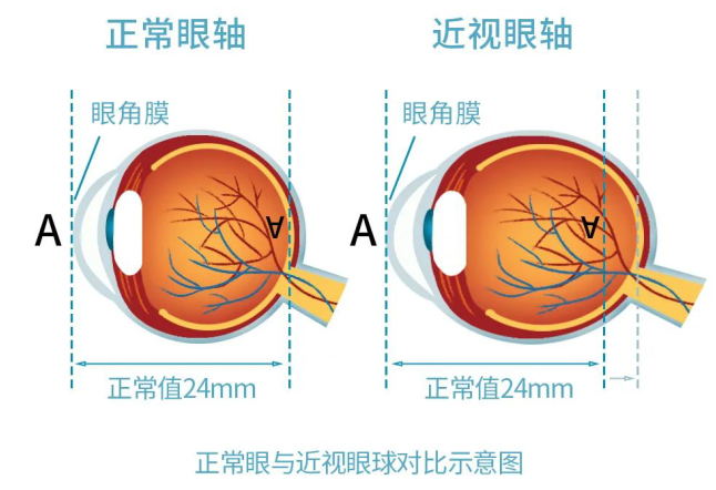 近視眼軸.jpg
