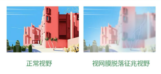 視網膜脫離視野.png