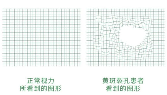 黃斑裂孔視界.jpg