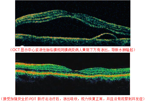 中心性視網(wǎng)膜炎黃斑水腫